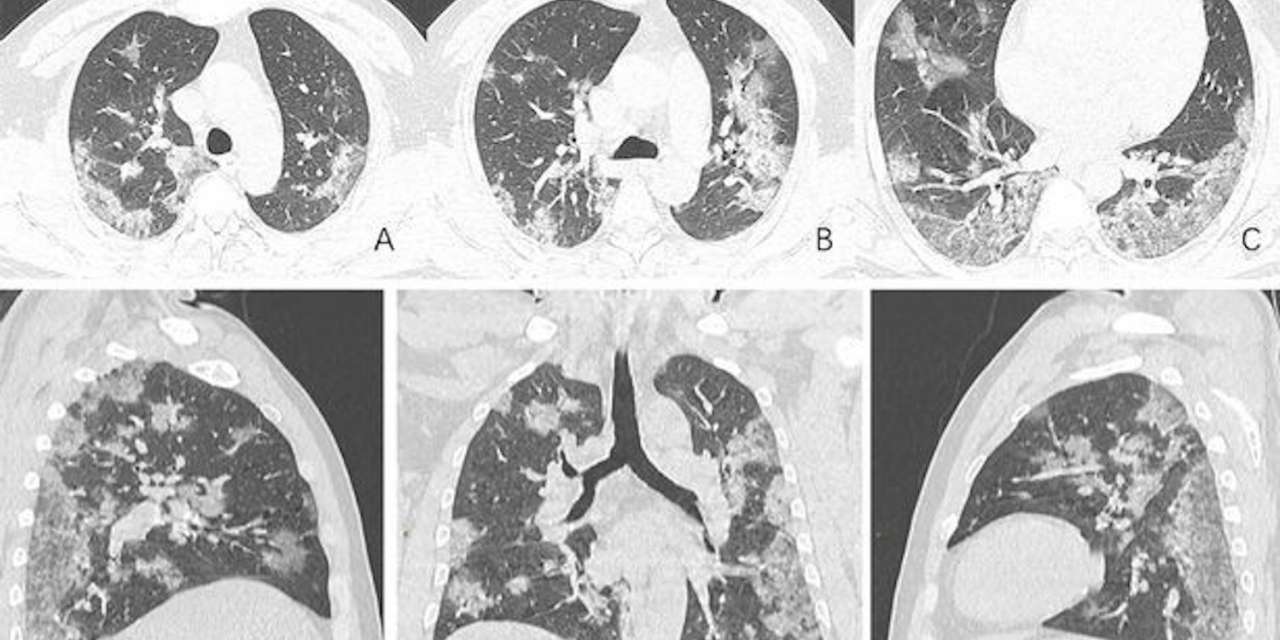 E depois de recuperar do Covid-19? Estas são as lesões que ficam num pulmão (Foto: Radiological Society of North America (RSNA))
