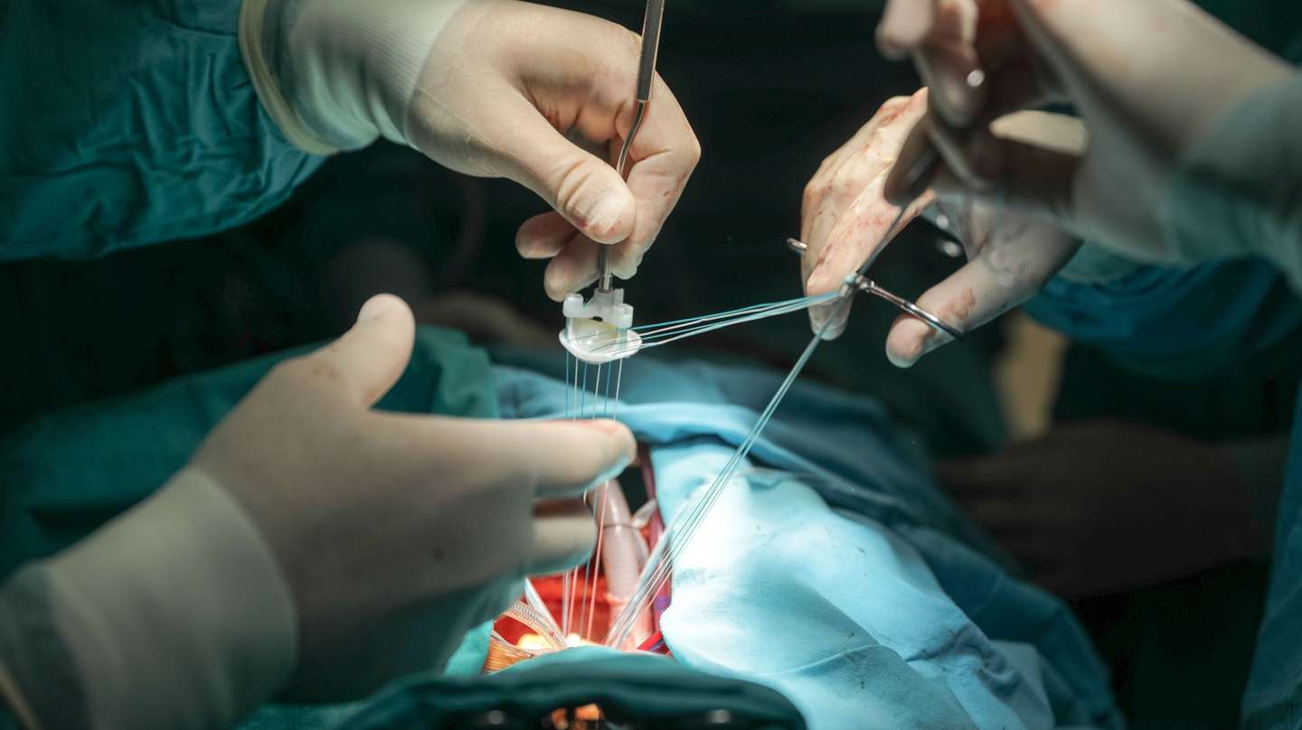 Operação de reparação da válvula mitral no Centro de Cirurgia Cardiotorácica do Centro Hospitalar e Universitário de Coimbra, fundado pelo cirurgião Manuel Antunes, que passa em julho à condição de aposentado, por atingir o limite de idade, nos Hospitais da Universidade de Coimbra, 2 de junho de 2018. (ACOMPANHA TEXTO DE 09/06/2018) PAULO NOVAIS/LUSA