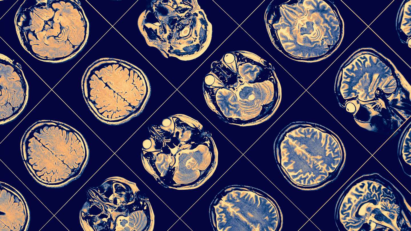 Alzheimer