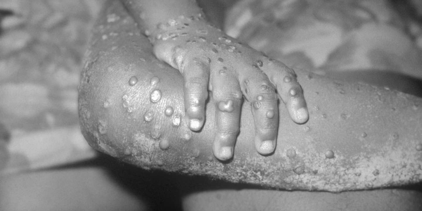 Monkey Pox Lesions