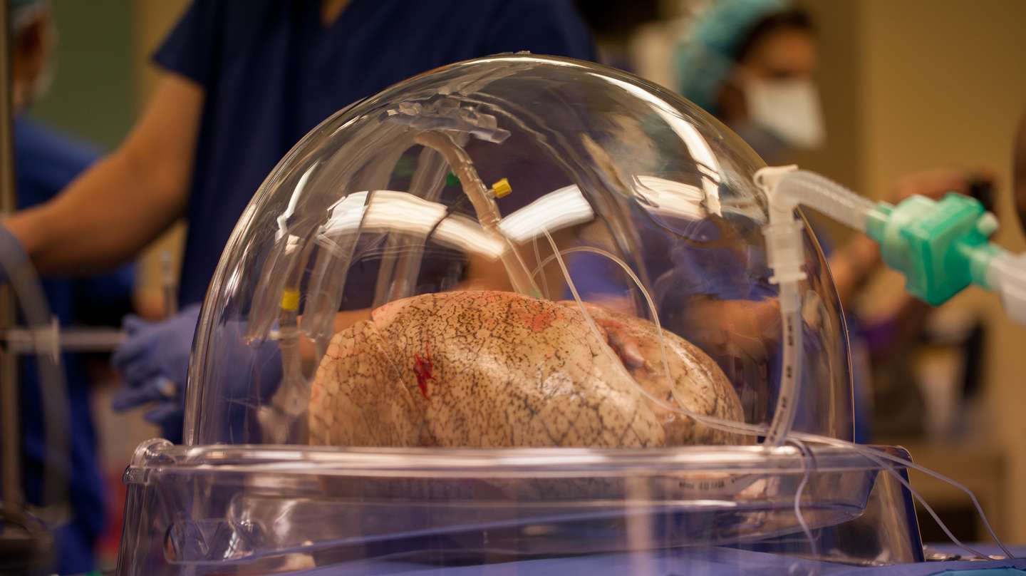 Double-lung Transplant Surgery