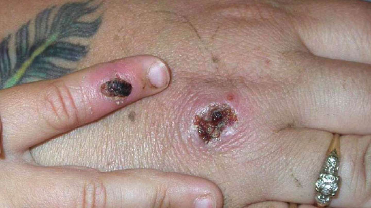 Monkey Pox Lesions