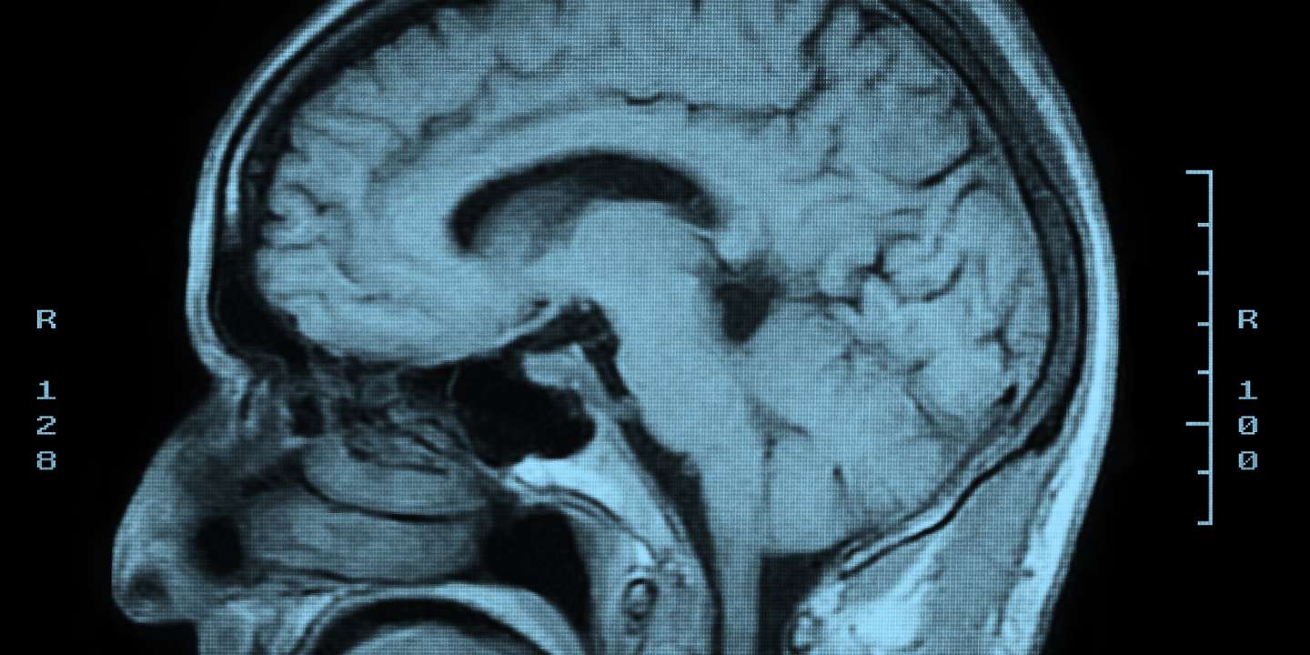 MRI Head Scan side view