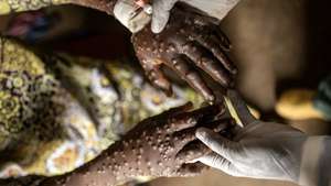 epaselect epa11582912 A mpox patient receives treatment at the Kavumu hospital in Karanrhada, Kamavu, South Kivu province, Democratic Republic of Congo, 03 September 2024. According to UNICEF, the Democratic Republic of Congo reports the highest number of cases, with over 18,000 suspected infections and 629 fatalities, 463 of them children. The World Health Organization (WHO) director-general on 14 August declared the ongoing outbreaks of mpox in Congo and elsewhere in Africa a Public Health Emergency of International Concern (PHEIC). Mpox causes fever, rash, and lesions all over the body, severe headaches, and fatigue.  EPA/MICHAEL LUNANGA