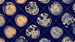Alzheimer