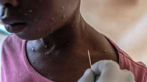 epaselect epa11555355 A boy receives treatment for mpox at the Munigi Health Centre in Munigi, Democratic Republic of the Congo, 19 August 2024. The World Health Organization (WHO) declared a global health emergency in response to the latest outbreak of mpox (monkeypox) in the Democratic Republic of Congo and other countries in Africa. Mpox, whose symptoms include fever, rash, lesions on all parts of the body, severe headaches, and fatigue, could lead to sepsis in severe cases, a life-threatening response to infection. Additionally, some children develop respiratory problems, have difficulty swallowing, and are at higher risk for secondary bacterial infections.  EPA/MOISE KASEREKA