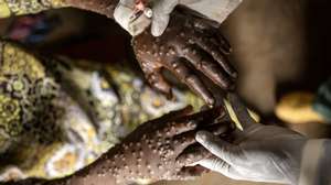 epa11582912 A mpox patient receives treatment at the Kavumu hospital in Karanrhada, Kamavu, South Kivu province, Democratic Republic of Congo, 03 September 2024. According to UNICEF, the Democratic Republic of Congo reports the highest number of cases, with over 18,000 suspected infections and 629 fatalities, 463 of them children. The World Health Organization (WHO) director-general on 14 August declared the ongoing outbreaks of mpox in Congo and elsewhere in Africa a Public Health Emergency of International Concern (PHEIC). Mpox causes fever, rash, and lesions all over the body, severe headaches, and fatigue.  EPA/MICHAEL LUNANGA