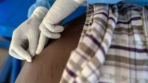 epa11555356 A young patient receives treatment for mpox at the Munigi Health Centre in Munigi, Democratic Republic of the Congo, 19 August 2024. The World Health Organization (WHO) declared a global health emergency in response to the latest outbreak of mpox (monkeypox) in the Democratic Republic of Congo and other countries in Africa. Mpox, whose symptoms include fever, rash, lesions on all parts of the body, severe headaches, and fatigue, could lead to sepsis in severe cases, a life-threatening response to infection. Additionally, some children develop respiratory problems, have difficulty swallowing, and are at higher risk for secondary bacterial infections.  EPA/MOISE KASEREKA