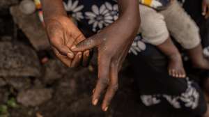 epa11556804 Tuliza Bisere shows her hands as she holds her daughter Ishara who was cured of mpox but still shows scars of the disease in the camp for internal displaced persons in Mudja, Democratic Republic of Congo, 20 August 2024. Democratic Republic of Congoâ€™s Health Minister Samuel-Boger Kamba said the death toll due to the mpox outbreak now stands at &#039;a little more than 570 deaths.&#039; The World Health Organization has declared the rise in mpox cases in the Democratic Republic of the Congo and neighboring countries a public health emergency, with over 27,000 cases and more than 1,100 deaths reported since January 2023. Symptoms include fever, body aches, and rashes, and while there is no specific treatment for mpox, supportive care can aid recovery. The virus spreads through close contact with infected individuals and can persist on contaminated surfaces.  EPA/MOISE KASEREKA