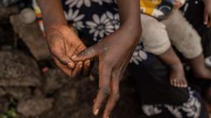 epa11556804 Tuliza Bisere shows her hands as she holds her daughter Ishara who was cured of mpox but still shows scars of the disease in the camp for internal displaced persons in Mudja, Democratic Republic of Congo, 20 August 2024. Democratic Republic of Congoâ€™s Health Minister Samuel-Boger Kamba said the death toll due to the mpox outbreak now stands at &#039;a little more than 570 deaths.&#039; The World Health Organization has declared the rise in mpox cases in the Democratic Republic of the Congo and neighboring countries a public health emergency, with over 27,000 cases and more than 1,100 deaths reported since January 2023. Symptoms include fever, body aches, and rashes, and while there is no specific treatment for mpox, supportive care can aid recovery. The virus spreads through close contact with infected individuals and can persist on contaminated surfaces.  EPA/MOISE KASEREKA