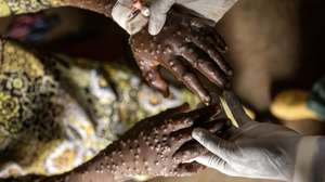 epaselect epa11582912 A mpox patient receives treatment at the Kavumu hospital in Karanrhada, Kamavu, South Kivu province, Democratic Republic of Congo, 03 September 2024. According to UNICEF, the Democratic Republic of Congo reports the highest number of cases, with over 18,000 suspected infections and 629 fatalities, 463 of them children. The World Health Organization (WHO) director-general on 14 August declared the ongoing outbreaks of mpox in Congo and elsewhere in Africa a Public Health Emergency of International Concern (PHEIC). Mpox causes fever, rash, and lesions all over the body, severe headaches, and fatigue.  EPA/MICHAEL LUNANGA