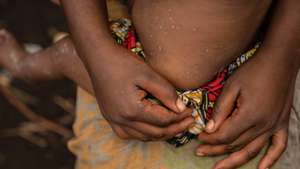 epa11556808 Foibe, an eight-month-old girl who was cured of mpox, still shows scars of the disease in the camp for internal displaced persons in Mudja, Democratic Republic of Congo, 20 August 2024. Democratic Republic of Congoâ€™s Health Minister Samuel-Boger Kamba said the death toll due to the mpox outbreak now stands at &#039;a little more than 570 deaths.&#039; The World Health Organization has declared the rise in mpox cases in the Democratic Republic of the Congo and neighboring countries a public health emergency, with over 27,000 cases and more than 1,100 deaths reported since January 2023. Symptoms include fever, body aches, and rashes, and while there is no specific treatment for mpox, supportive care can aid recovery. The virus spreads through close contact with infected individuals and can persist on contaminated surfaces.  EPA/MOISE KASEREKA