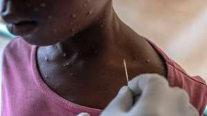 epaselect epa11555355 A boy receives treatment for mpox at the Munigi Health Centre in Munigi, Democratic Republic of the Congo, 19 August 2024. The World Health Organization (WHO) declared a global health emergency in response to the latest outbreak of mpox (monkeypox) in the Democratic Republic of Congo and other countries in Africa. Mpox, whose symptoms include fever, rash, lesions on all parts of the body, severe headaches, and fatigue, could lead to sepsis in severe cases, a life-threatening response to infection. Additionally, some children develop respiratory problems, have difficulty swallowing, and are at higher risk for secondary bacterial infections.  EPA/MOISE KASEREKA