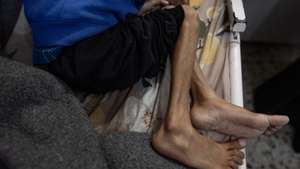 epa12147327 Five year-old Osama al-Raqab, suffering from severe malnutrition, undergoes treatment at the Nasser Hospital in Khan Youni in the southern Gaza Strip 31 May 2025. His mother, Mona al-Raqab says Osama's weight has dropped to just nine kilograms due to his deteriorating health condition caused by ongoing malnutrition. The UN has stated that families are being starved and denied the basic means for survival and only a trickle of aid that falls short of people's massive needs has entered the Gaza Strip after more than 80 days of a total blockade by Israeli authorities. The UN stated that Gaza is the only territory in the world where an entire population is at risk of famine.  EPA/HAITHAM IMAD ATTENTION EDITORS: UPSETTING CONTENT