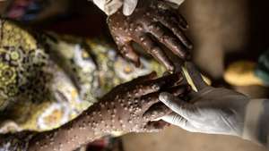 epa11756163 An mpox patient is treated at the Kavumu hospital in Karanrhada, Kamavu, South Kivu province, Democratic Republic of Congo, 03 September 2024.  EPA/MICHAEL LUNANGA