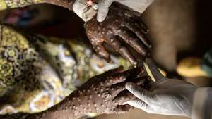 epa11756163 An mpox patient is treated at the Kavumu hospital in Karanrhada, Kamavu, South Kivu province, Democratic Republic of Congo, 03 September 2024.  EPA/MICHAEL LUNANGA