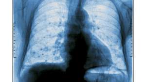metastases pulmao