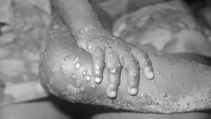 Monkey Pox Lesions