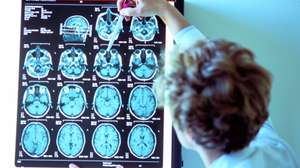Alzheimer
