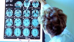 Alzheimer