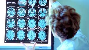 Alzheimer