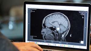 Radiografia que mostra um tumor cerebral