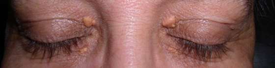 xanthelasma_1200x300_acf_cropped