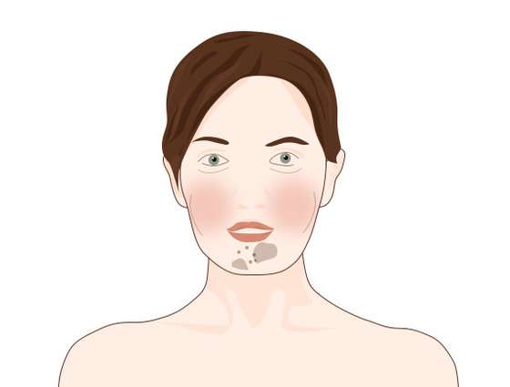 gluten_face2