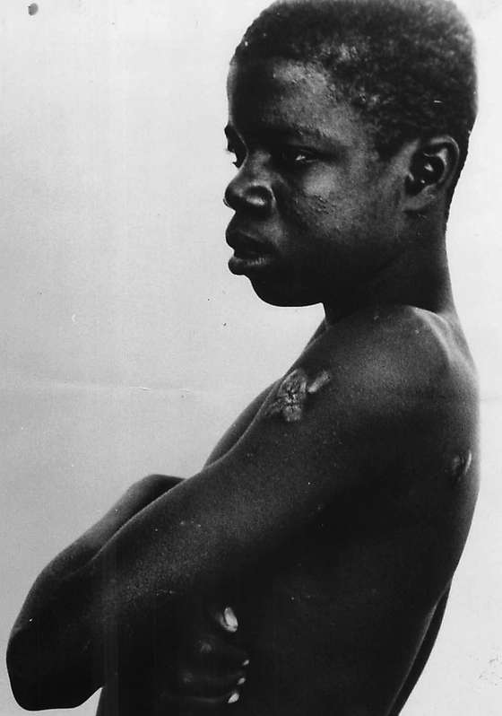 Ant&Atilde;&sup3;nio Mixone, sobrevivente do ataque a Chaworha, 1973