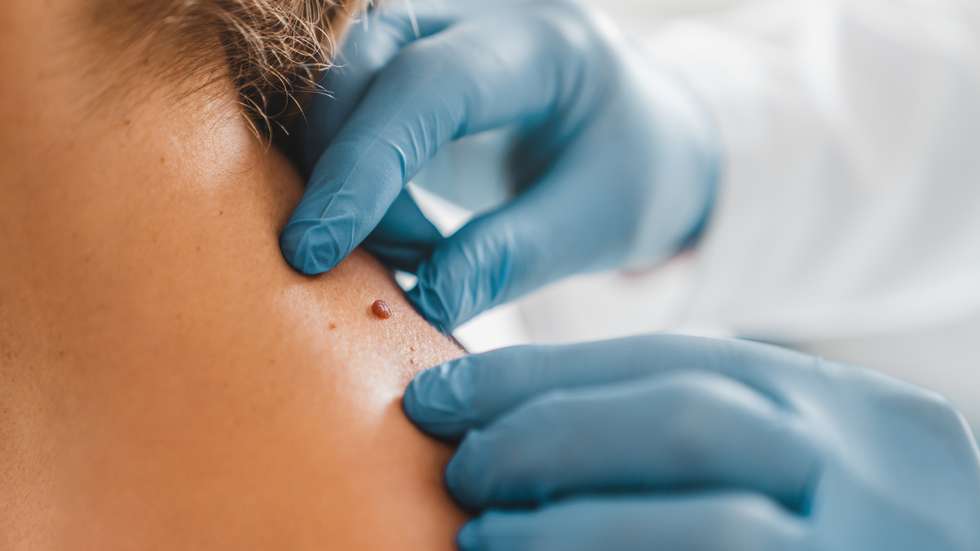 Melanoma é o tipo mais agressivo de cancro da pele,