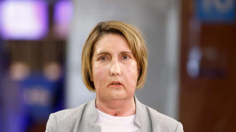 Carme recebeu o primeiro transplante facial de uma doadora que morreu após uma eutanásia