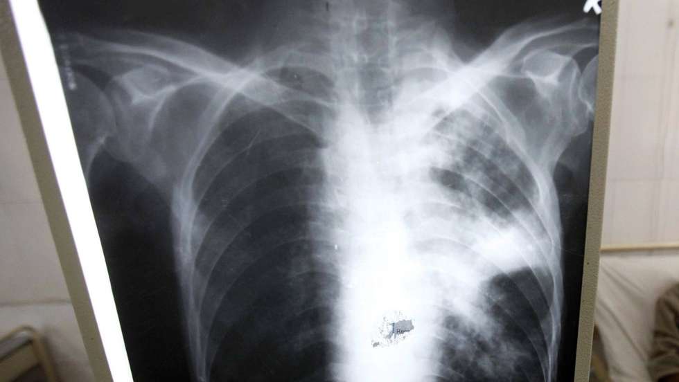 A tuberculose pulmonar transmite-se sobretudo pelo ar, quando uma pessoa com a doença liberta pequenas partículas infetadas ao tossir, falar ou espirrar