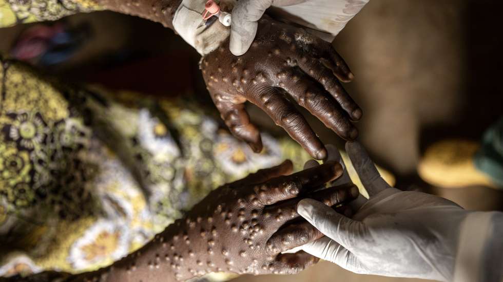 epa11582912 A mpox patient receives treatment at the Kavumu hospital in Karanrhada, Kamavu, South Kivu province, Democratic Republic of Congo, 03 September 2024. According to UNICEF, the Democratic Republic of Congo reports the highest number of cases, with over 18,000 suspected infections and 629 fatalities, 463 of them children. The World Health Organization (WHO) director-general on 14 August declared the ongoing outbreaks of mpox in Congo and elsewhere in Africa a Public Health Emergency of International Concern (PHEIC). Mpox causes fever, rash, and lesions all over the body, severe headaches, and fatigue.  EPA/MICHAEL LUNANGA