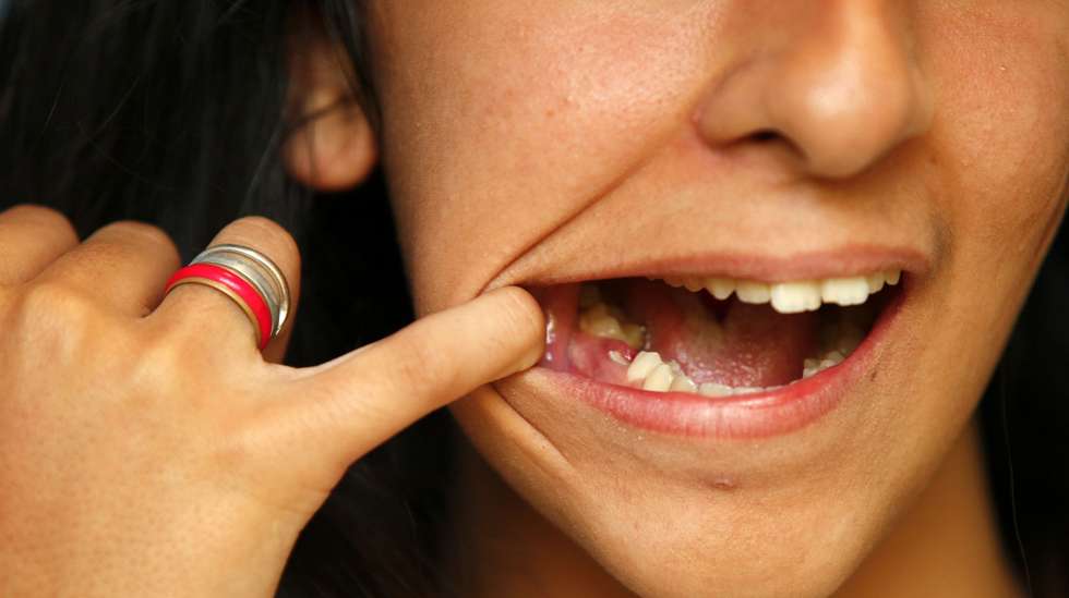 Estudo indica que 96,3% dos portugueses defendem que o Estado deveria comparticipar os tratamentos dentários
