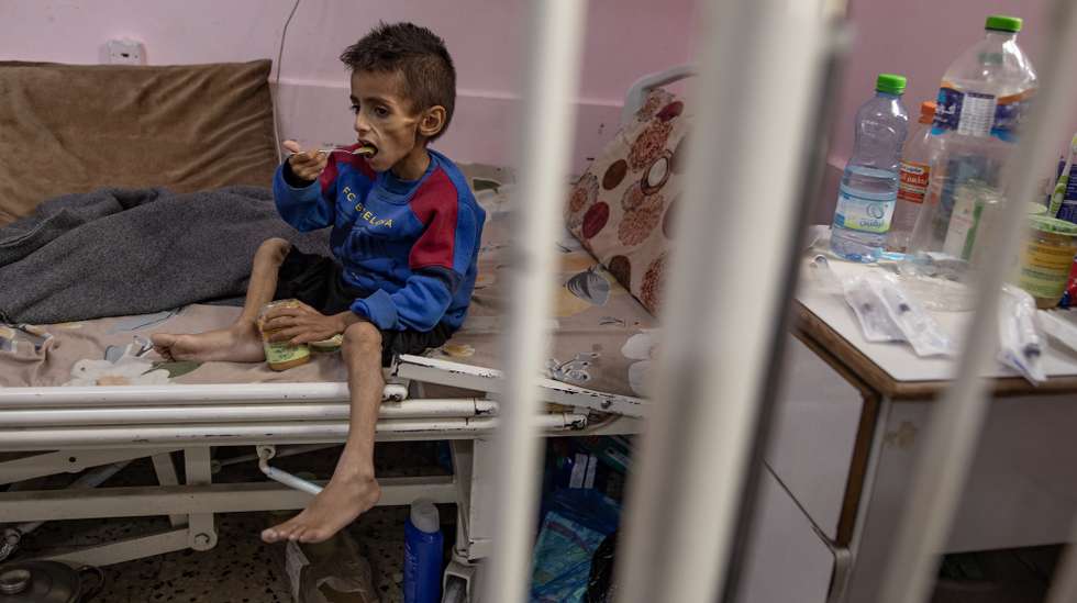 epa12147328 Five year-old Osama al-Raqab, suffering from severe malnutrition, undergoes treatment at the Nasser Hospital in Khan Youni in the southern Gaza Strip 31 May 2025. His mother, Mona al-Raqab says Osama's weight has dropped to just nine kilograms due to his deteriorating health condition caused by ongoing malnutrition. The UN has stated that families are being starved and denied the basic means for survival and only a trickle of aid that falls short of people's massive needs has entered the Gaza Strip after more than 80 days of a total blockade by Israeli authorities. The UN stated that Gaza is the only territory in the world where an entire population is at risk of famine.  EPA/HAITHAM IMAD ATTENTION EDITORS: UPSETTING CONTENT