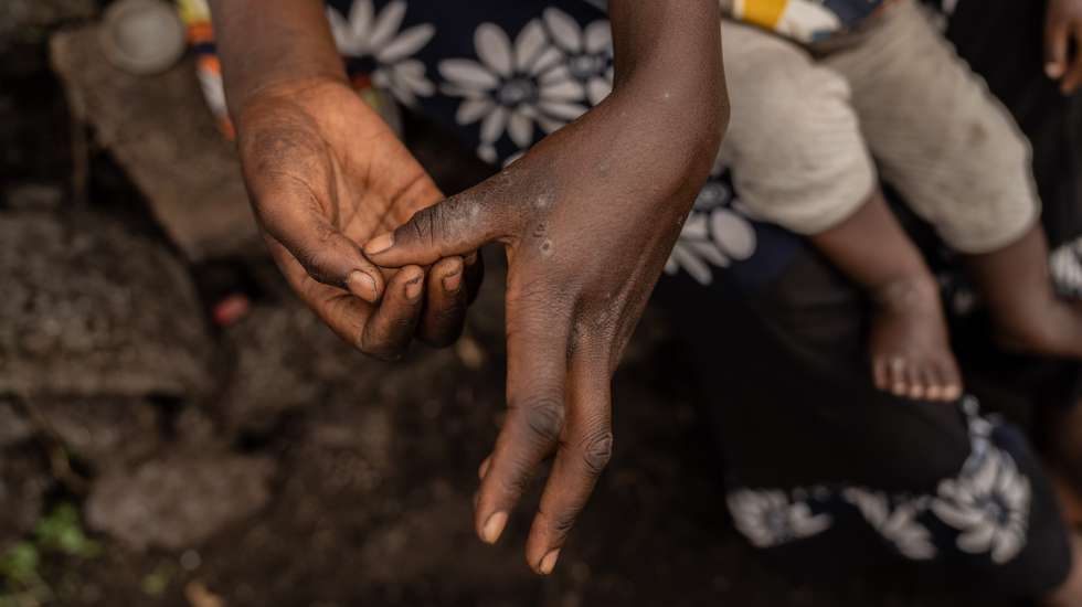 epa11556804 Tuliza Bisere shows her hands as she holds her daughter Ishara who was cured of mpox but still shows scars of the disease in the camp for internal displaced persons in Mudja, Democratic Republic of Congo, 20 August 2024. Democratic Republic of Congoâ€™s Health Minister Samuel-Boger Kamba said the death toll due to the mpox outbreak now stands at 'a little more than 570 deaths.' The World Health Organization has declared the rise in mpox cases in the Democratic Republic of the Congo and neighboring countries a public health emergency, with over 27,000 cases and more than 1,100 deaths reported since January 2023. Symptoms include fever, body aches, and rashes, and while there is no specific treatment for mpox, supportive care can aid recovery. The virus spreads through close contact with infected individuals and can persist on contaminated surfaces.  EPA/MOISE KASEREKA