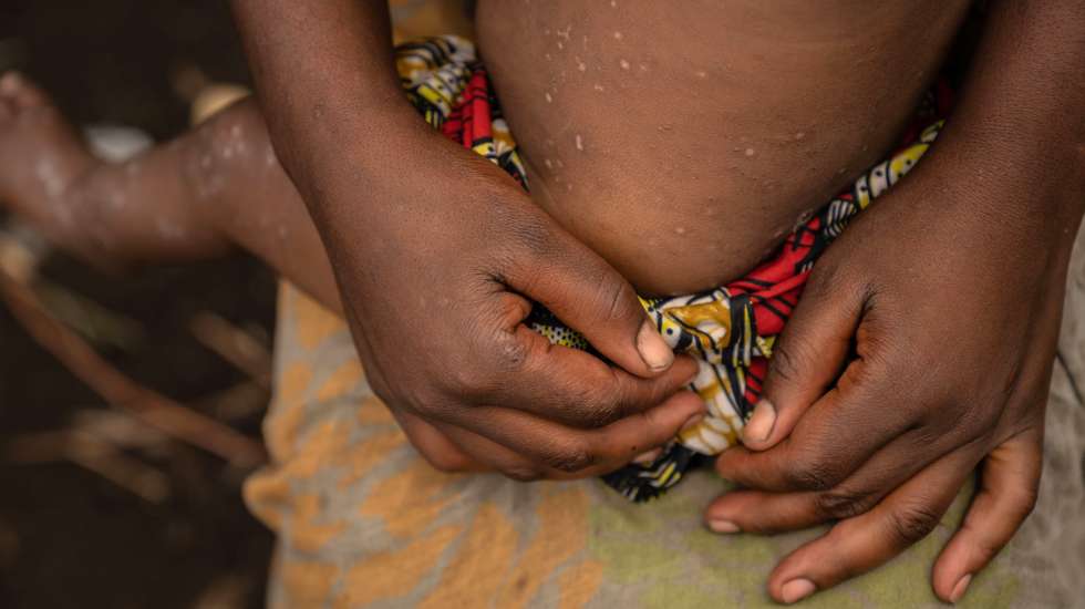 epa11556808 Foibe, an eight-month-old girl who was cured of mpox, still shows scars of the disease in the camp for internal displaced persons in Mudja, Democratic Republic of Congo, 20 August 2024. Democratic Republic of Congoâ€™s Health Minister Samuel-Boger Kamba said the death toll due to the mpox outbreak now stands at 'a little more than 570 deaths.' The World Health Organization has declared the rise in mpox cases in the Democratic Republic of the Congo and neighboring countries a public health emergency, with over 27,000 cases and more than 1,100 deaths reported since January 2023. Symptoms include fever, body aches, and rashes, and while there is no specific treatment for mpox, supportive care can aid recovery. The virus spreads through close contact with infected individuals and can persist on contaminated surfaces.  EPA/MOISE KASEREKA