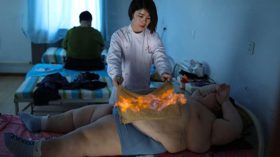 epa05660556 YEARENDER 2016 NOVEMBER
A Chinese medicine doctor performs 'huo liao' or 'fire therapy' on 11-year-old patient Li Hang to help him lose excess weight at the Changchun Kangda Hospital, in Changchun city, Jilin Province, China, 25 November 2016. Li Hang initially weighed 167 kilograms and is undergoing treatment at the clinic for obesity caused by a genetic disorder called Prader-Willi syndrome (PWS).  EPA/Tian Weitao CHINA OUT