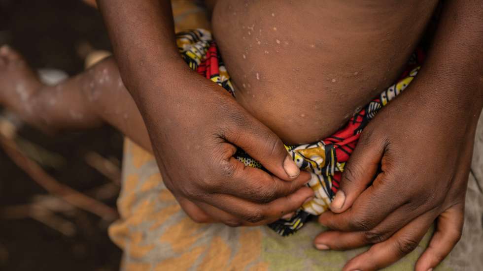 epa11556808 Foibe, an eight-month-old girl who was cured of mpox, still shows scars of the disease in the camp for internal displaced persons in Mudja, Democratic Republic of Congo, 20 August 2024. Democratic Republic of Congoâ€™s Health Minister Samuel-Boger Kamba said the death toll due to the mpox outbreak now stands at 'a little more than 570 deaths.' The World Health Organization has declared the rise in mpox cases in the Democratic Republic of the Congo and neighboring countries a public health emergency, with over 27,000 cases and more than 1,100 deaths reported since January 2023. Symptoms include fever, body aches, and rashes, and while there is no specific treatment for mpox, supportive care can aid recovery. The virus spreads through close contact with infected individuals and can persist on contaminated surfaces.  EPA/MOISE KASEREKA