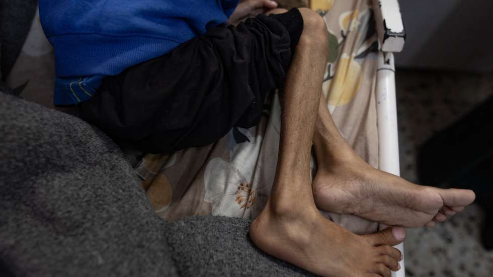 epa12147327 Five year-old Osama al-Raqab, suffering from severe malnutrition, undergoes treatment at the Nasser Hospital in Khan Youni in the southern Gaza Strip 31 May 2025. His mother, Mona al-Raqab says Osama's weight has dropped to just nine kilograms due to his deteriorating health condition caused by ongoing malnutrition. The UN has stated that families are being starved and denied the basic means for survival and only a trickle of aid that falls short of people's massive needs has entered the Gaza Strip after more than 80 days of a total blockade by Israeli authorities. The UN stated that Gaza is the only territory in the world where an entire population is at risk of famine.  EPA/HAITHAM IMAD ATTENTION EDITORS: UPSETTING CONTENT