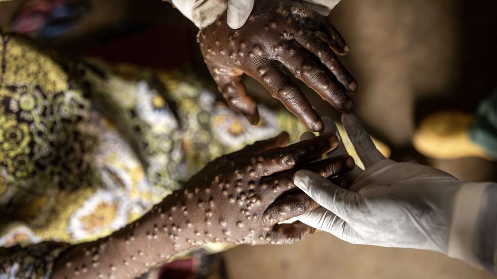 epa11756163 An mpox patient is treated at the Kavumu hospital in Karanrhada, Kamavu, South Kivu province, Democratic Republic of Congo, 03 September 2024.  EPA/MICHAEL LUNANGA