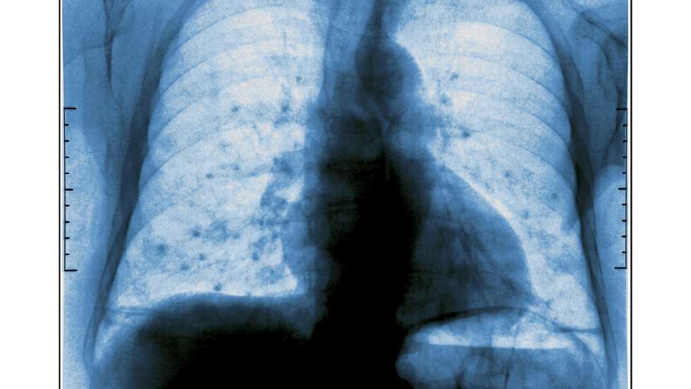 metastases pulmao