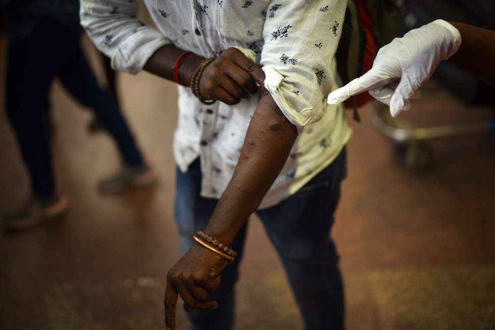 epa10074096 Indian health workers screen passengers arrivingÂ from high-risk countries for symptoms of the MonkeypoxÂ virus, as India reported the first case of Monkeypox in the WHO South-East Asia Region, at Chennai International Airport, in Chennai, India, 16 July 2022. The Tamil Nadu state public health department has started screening international passengers landing in the state of Tamil Nadu for symptoms of the MonkeypoxÂ virus as the first confirmed case of WHO South-East Asia Region has been reported in India after a traveler from Kerala who recently returned from the Middle East tested positive for the Monkeypox virus on 14 July 2022. The Tamil Nadu state government has increased the surveillanceÂ across the borders sharing with the state of Kerala and started screening at all international airports in Tamil Nadu.  EPA/IDREES MOHAMMED