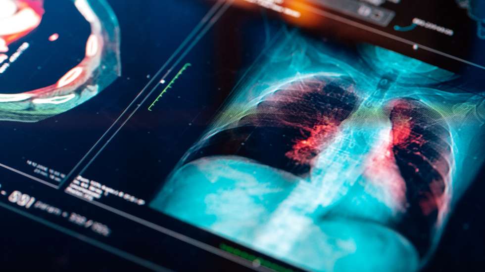 Os Açores registaram as taxas de mortalidade por cancro mais elevadas do país