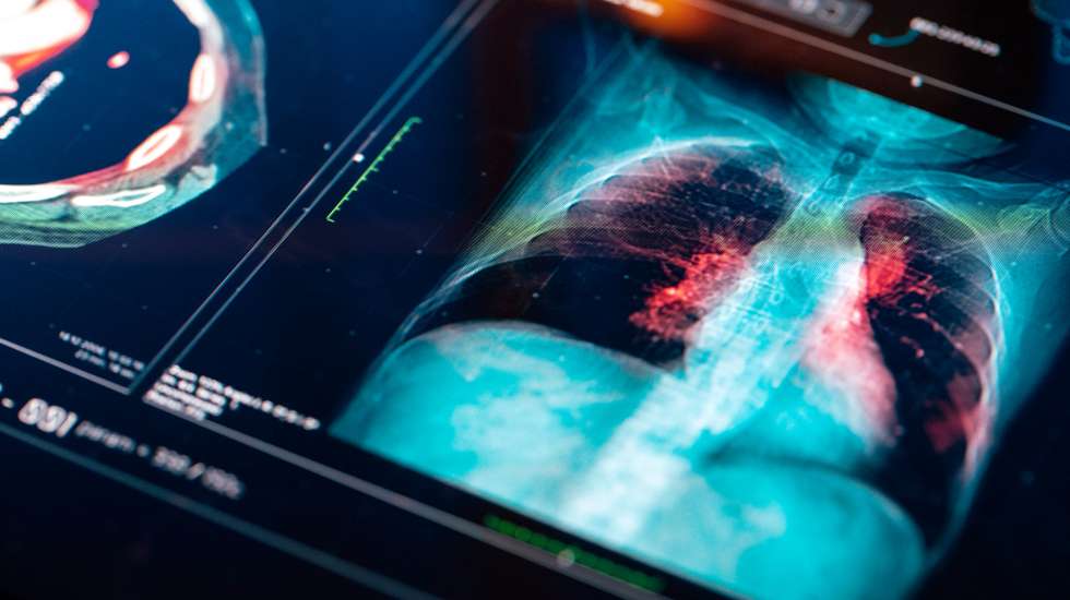 Na mulher, o cancro da mama foi o principal responsável pela mortalidade por cancro, enquanto no homem, foi o cancro do pulmão