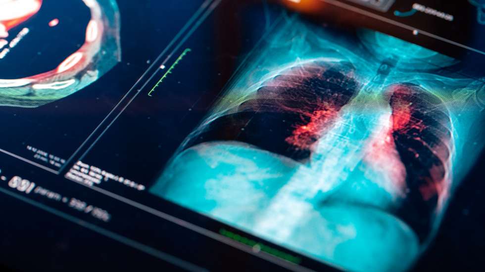 Em 2021, em Portugal diagnosticaram-se 60.717 novos casos de cancro