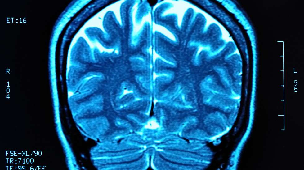 MRI a um cérebro