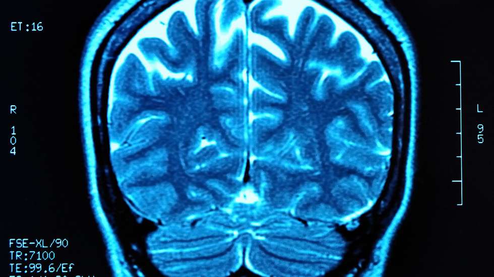 MRI a um cérebro