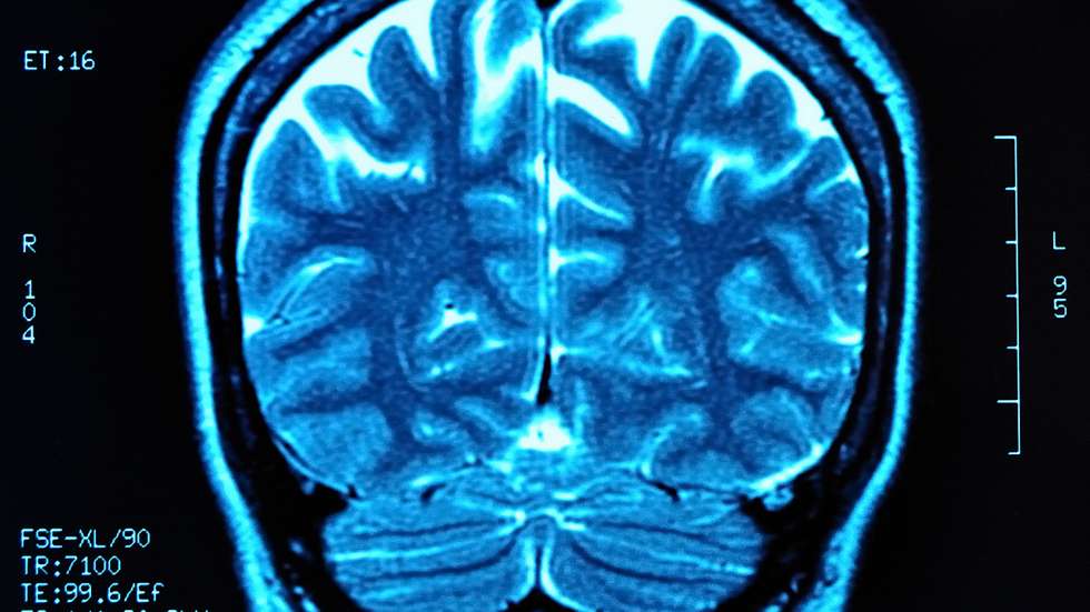 MRI a um cérebro