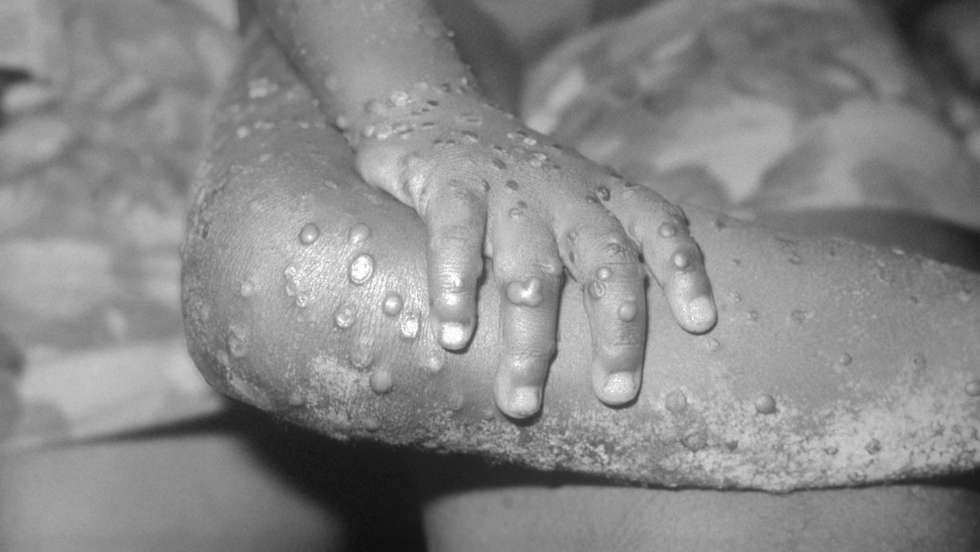 Monkey Pox Lesions